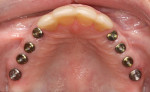 Figure 5  Occlusal view of implants with healing caps.