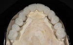 Figure 9  Occlusal view of provisionals.