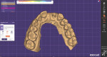 (1.) Pretreatment design software view of the maxillary arch of a 50-year-old male patient who presented with a fractured root tip at the site of tooth No. 10 and an edentulous space at the site of tooth No. 9.