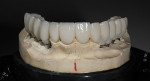 Figure 10  Buccal view of provisionals.