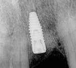 (10.) A postoperative radiograph was acquired to assess the final position and angulation of the implant.