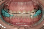 Figure 7  Kois Deprogrammer used to develop new vertical occlusion and bite registration (MegaBite, Discus Dental).