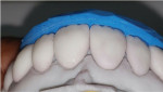 Fig 14. Cutback of the incisal third. The index was used by the ceramist to reestablish the correct incisal length. Add-on material was used to layer the veneers for enhanced vitality.