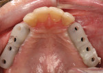 Figure 21  Custom titanium abutments are tried in with the aid of the custom placement jigs.