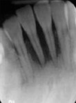 Fig 3. Periapical
radiograph showing severe bone loss around the lower incisors.