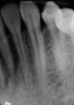 Fig 4.
Additional radiograph showing severe bone loss around the lower incisors
with a clearer view of tooth No. 23.
