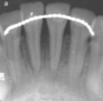 Fig 12. Periapical radiograph at 5 months postoperative.