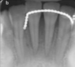 Fig 13. Periapical radiograph at 10 months postoperative.