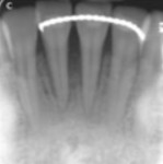 Fig 14. Periapical radiograph at 18 months postoperative.