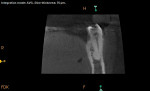 Fig 2. Coronal
CBCT slice demonstrating the
extent of the radiopacity.