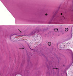 Fig 4. (Top image) Histologic features of the lesion on biopsy. A dense proliferation
of generally hypocellular cementum (*) was present immediately adjacent
to the affected tooth (+) (hematoxylin and eosin [H&E] stain).