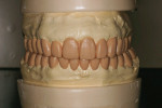 Figure 8  Full-mouth wax-up established from patient’s new vertical change.