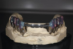 Figure 30  Primotec light-cured composite is used for coping construction and splinting.