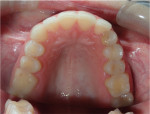 Fig 2. Occlusal view of the maxillary over-retained deciduous canine and adjacent dentition.