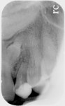 Fig 3. Periapical radiograph demonstrating the maxillary over-retained deciduous left canine with one of the two supernumerary teeth present coronal to the impacted permanent canine.