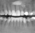 Fig 4. CBCT 3D panoramic view demonstrating a maxillary impacted permanent canine positioned horizontally apical to the dentition and impacted supernumerary teeth apical to the over-retained deciduous canine.