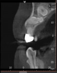 Fig 5. CBCT sagittal view identifying the impacted permanent canine oriented on the horizontal plane with two supernumerary teeth coronal to the impacted canine.