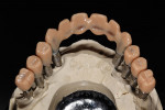 Figure 35  Occlusal view of frameworks before casting.