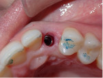 Fig 9. Occlusal view of the implant placed following extraction of the deciduous canine.