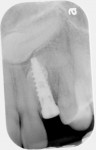 Fig 10. Periapical radiograph after implant placement at the extraction site with engagement of the supernumerary tooth.