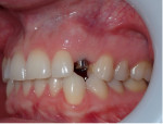 Fig 11. Buccal view at 3 months healing after implant uncovery and placement of a healing abutment; site was now ready for initiation of restoration of the implant.
