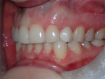 Fig 13. Buccal view of the restored implant at 6 months post–implant placement demonstrating maintenance of the ridge contours and absence of gingival inflammation.