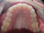 Fig 14. Occlusal view of the restored implant at 6 months post–implant placement.