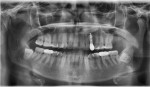 Fig 15. Panoramic radiograph at 15 months post–implant placement (10 months post-restoration) showing orientation of the implant in relation to the impacted permanent canine and supernumerary teeth and maintenance of bone.