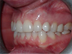 Fig 16. Buccal view of the restored implant 3-years 8-months post–implant placement demonstrating maintenance of the ridge contours and an absence of gingival inflammation.