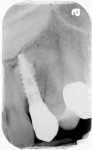 Fig 17. Periapical radiograph 3-years 8-months post–implant placement demonstrating bone maintenance around the implant and at the areas of contact with the impacted supernumerary teeth.