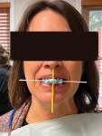 (2.) Bite photograph taken with horizontal and vertical sticks to show facial midline and horizontal plane parallel to the interpupillary line.