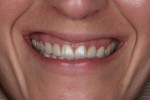 Fig 2. Pretreatment close-up view of the patient’s Duchenne smile.
