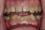 Fig 3. Pretreatment anterior. Note severe destruction to most of the
patient’s teeth.