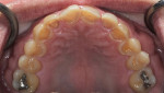 Fig 4. Pretreatment maxillary occlusal view. Note severe enamel loss.