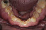 Fig 5. Pretreatment mandibular occlusal view. Note severe
enamel loss.