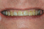 Fig 6. Pretreatment Duchenne smile. Note gingival display.