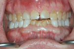 Fig 9. Mandibular posterior crowns post-cementation
at an increased VDO to allow for phased treatment.