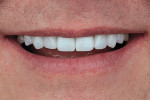 Fig 11. Post-treatment close-up view of the patient’s smile.