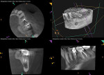 Fig 2. CBCT scan of the mandibular left mandible
demonstrating interruptions in the cortex on the
lingual torus and bony sequestra.