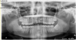 Fig 1. Panoramic radiograph
showing the “double tooth” at
the mandibular left impacted
third molar.
