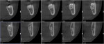 Fig 2. CBCT showing
the relation between the
“double tooth” and the IAN
position.