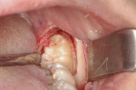 Fig 3. Occlusal view of the “double tooth.”