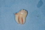 Fig 4. Vestibular view of the
extracted abnormal third molar.