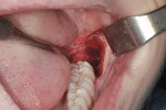 Fig 5. Occlusal view of the alveolar
socket after extraction of the “double” third molar.