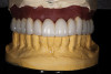 Figure 2   Laboratory alteration of the gingival contours in the diagnostic wax-up.