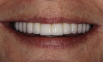 Figure 64  Patients smile at seating.