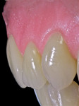 Figure 21  This is a lateral view of the denture tooth set-up.