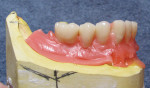 Figure 7  Placement of posterior teeth.