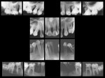 Figure 1  Radiographic appearance of a 17-year-old female with severe periodontal destruction.