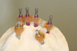 Figure 4  The intraoral luting jig for the verified impression, finished and sectioned.